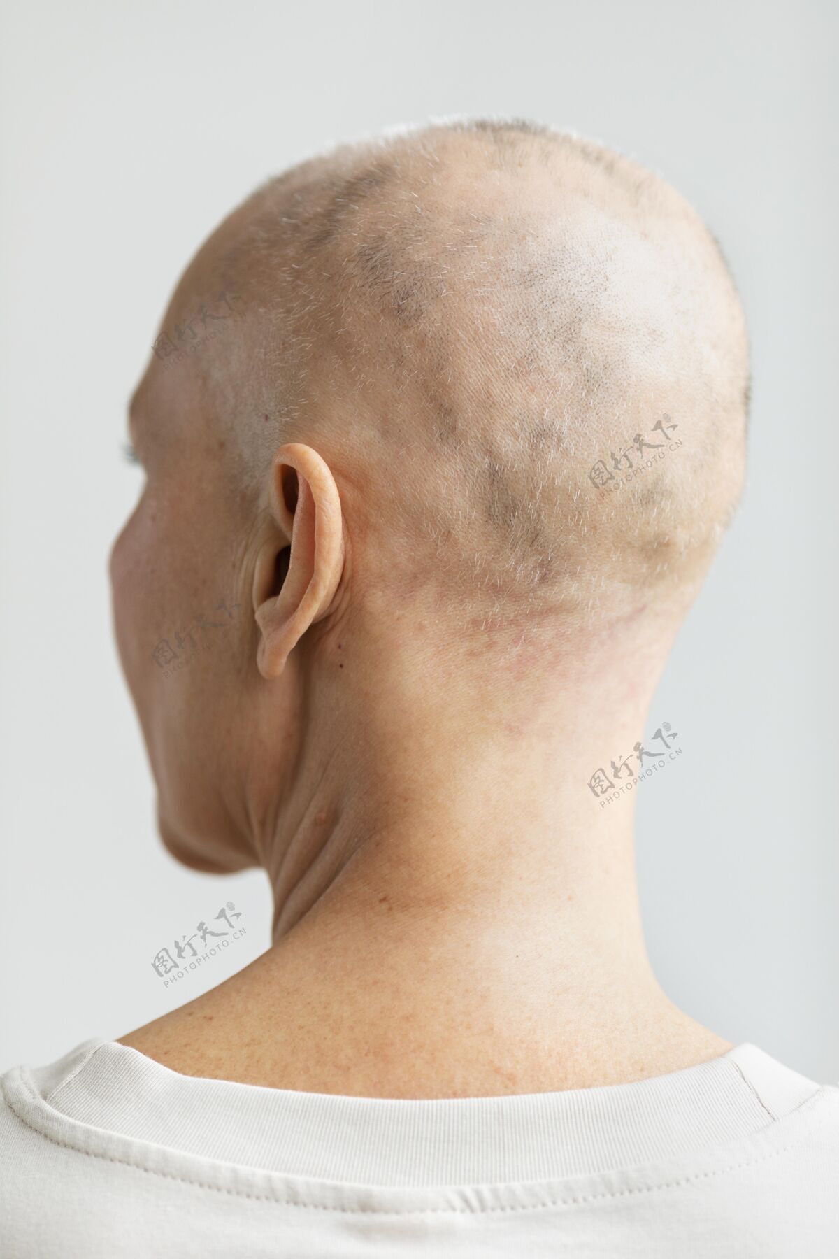 医疗皮肤癌的女人癌症女人秃头
