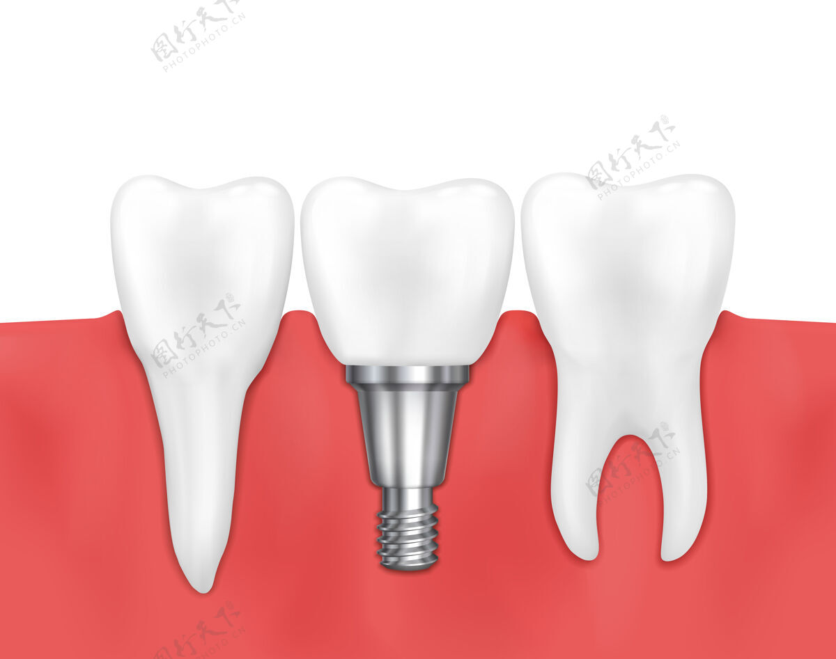 牙龈牙种植和正常牙齿插图骨植入医疗保健